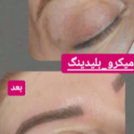 میکروبلیدینگ ابرو