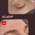 میکروبلیدینگ ابرو