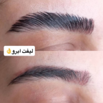 لیفت ابرو