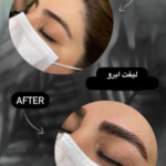 لیفت ابرو