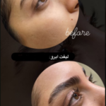 لیفت ابرو