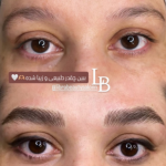 میکروبلیدینگ ابرو